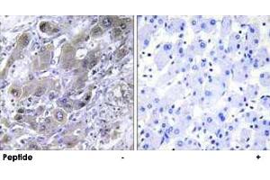 Immunohistochemistry analysis of paraffin-embedded human liver carcinoma tissue using MRPS18A polyclonal antibody . (MRPS18A antibody)