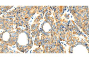 Immunohistochemistry of paraffin-embedded Human thyroid cancer tissue using RIPK4 Polyclonal Antibody at dilution 1:40