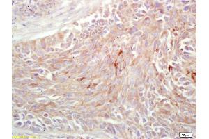 Formalin-fixed and paraffin embedded human lung carcinoma labeled with Rabbit Anti EMR1 Polyclonal Antibody, Unconjugated (ABIN1387314) at 1:200 followed by conjugation to the secondary antibody and DAB staining (F4/80 antibody  (AA 732-747))