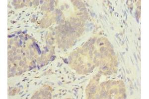 Immunohistochemistry of paraffin-embedded human gastric cancer using ABIN7165819 at dilution of 1:100 (MSTO1 antibody  (AA 1-280))
