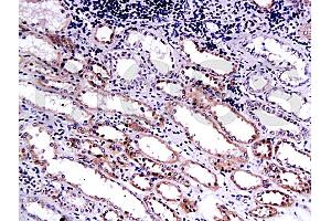 Formalin-fixed and paraffin embedded human kidney carcinoma labeled with Anti-Endostatin Polyclonal Antibody (ABIN669951), Unconjugated at 1:200, followed by conjugation to the secondary antibody and DAB staining
