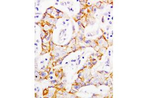 Anti-beta Catenin antibody, IHC(P) IHC(P): Human Mammary Cancer Tissue (CTNNB1 antibody  (C-Term))