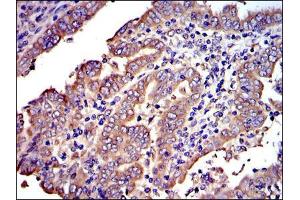 Immunohistochemical analysis of paraffin-embedded intima cancer tissues using CRK mouse mAb with DAB staining. (Crk antibody)