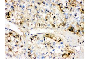 Anti- AHSG Picoband antibody, IHC(P) IHC(P): Human Liver Cancer Tissue (Fetuin A antibody  (N-Term))