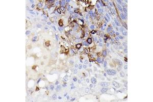 Immunohistochemistry of paraffin-embedded Human esophageal cancer using /IB antibody (527) at dilution of 1:50 (40x lens). (Iba1 antibody  (AA 1-147))