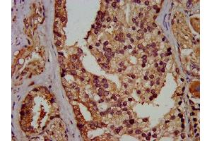 IHC image of ABIN7152156 diluted at 1:400 and staining in paraffin-embedded human prostate cancer performed on a Leica BondTM system. (EIF3G antibody  (AA 2-320))