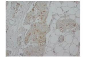 Immunohistochemical FLIPL antibody staining of Human Mammary Cancer Paraffin Sections.