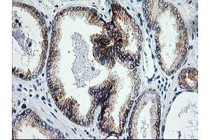 Immunohistochemical staining of paraffin-embedded Carcinoma of Human prostate tissue using anti-ERCC4 mouse monoclonal antibody.