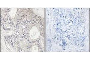 Immunohistochemistry analysis of paraffin-embedded human breast carcinoma tissue, using Cytochrome P450 1A2 Antibody. (CYP1A2 antibody  (AA 331-380))