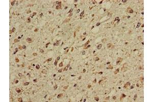 Immunohistochemistry of paraffin-embedded human glioma using ABIN7146829 at dilution of 1:100 (CPT1C antibody  (AA 699-803))