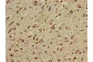 Immunohistochemistry of paraffin-embedded human glioma using ABIN7146829 at dilution of 1:100
