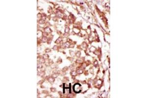 Formalin-fixed and paraffin-embedded human cancer tissue reacted with the primary antibody, which was peroxidase-conjugated to the secondary antibody, followed by DAB staining. (BUB1B antibody  (N-Term))