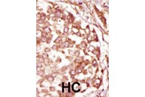 Formalin-fixed and paraffin-embedded human cancer tissue reacted with the primary antibody, which was peroxidase-conjugated to the secondary antibody, followed by DAB staining.