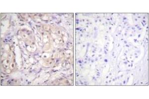 Immunohistochemistry analysis of paraffin-embedded human breast carcinoma, using B-RAF (Phospho-Thr599) Antibody.