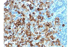 Formalin-fixed, paraffin-embedded human Melanoma stained with gp100 Rabbit Recombinant Monoclonal Antibody (PMEL/1825R). (Recombinant Melanoma gp100 antibody)