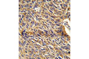 Formalin-fixed and paraffin-embedded human lung carcinoma reacted with DCI Antibody , which was peroxidase-conjugated to the secondary antibody, followed by DAB staining. (DCI antibody  (C-Term))