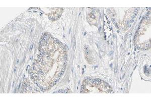 ABIN6272978 at 1/100 staining Human prostate tissue by IHC-P. (PYGL antibody  (Internal Region))