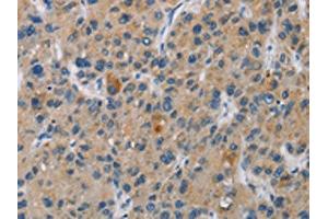 The image is immunohistochemistry of paraffin-embedded Human liver cancer tissue using ABIN7130969(SAR1B Antibody) at dilution 1/20. (SAR1B antibody)
