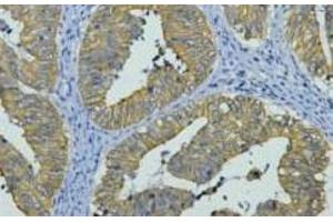 Immunohistochemistry of paraffin-embedded Human colon cancer tissue using CK-8 Monoclonal Antibody at dilution of 1:200. (KRT8 antibody)