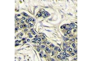 IHC analysis of FFPE human breast carcinoma stained with PI3KCA antibody (PIK3CA antibody  (AA 504-533))