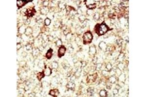 IHC analysis of FFPE human hepatocarcinoma tissue stained with the FGFR4 antibody (FGFR4 antibody  (AA 24-55))