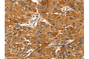 The image on the left is immunohistochemistry of paraffin-embedded Human liver cancer tissue using ABIN7131212(STARD8 Antibody) at dilution 1/20, on the right is treated with fusion protein. (STARD8 antibody)