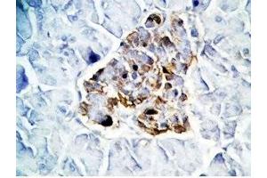 Human pancreas cancer tissue was stained by Rabbit Anti-GLP-1(7-36) -NH2 Antibody (GLP-1 antibody  (amidated))
