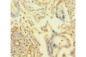 Immunohistochemistry of paraffin-embedded human pancreatic cancer using ABIN7167948 at dilution of 1:100