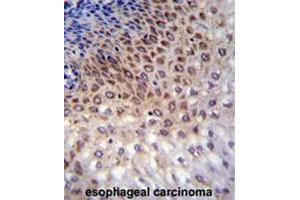 CCDC36 Antibody (C-term) immunohistochemistry analysis in formalin fixed and paraffin embedded human esophageal carcinoma followed by peroxidase conjugation of the secondary antibody and DAB staining. (CCDC36 antibody  (C-Term))