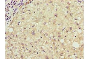 Immunohistochemistry of paraffin-embedded human liver cancer using ABIN7168042 at dilution of 1:100 (RHOJ antibody  (AA 1-211))