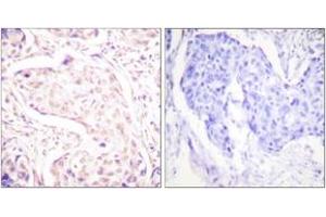 Immunohistochemistry analysis of paraffin-embedded human breast carcinoma tissue, using Fos (Ab-362) Antibody. (c-FOS antibody  (AA 331-380))