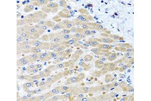 Immunohistochemistry of paraffin-embedded Human liver damage using DARS2 Polyclonal Antibody at dilution of 1:100 (40x lens). (DARS2 antibody)