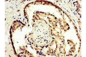 IHC image of ABIN7163426 diluted at 1:300 and staining in paraffin-embedded human prostate cancer performed on a Leica BondTM system. (NR2E3 antibody  (AA 112-222))