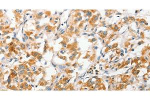 Immunohistochemistry of paraffin-embedded Human thyroid cancer tissue using ANAPC2 Polyclonal Antibody at dilution 1:30 (ANAPC2 antibody)