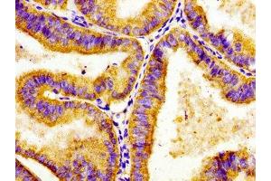 Immunohistochemistry of paraffin-embedded human endometrial cancer using ABIN7143338 at dilution of 1:100 (ADCY8 antibody  (AA 534-670))