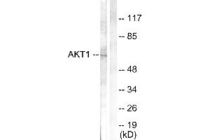 Immunohistochemistry analysis of paraffin-embedded human breast carcinoma tissue using Akt (Ab-308) antibody. (AKT1 antibody  (Thr308))
