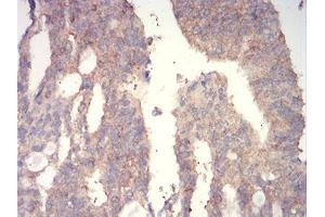 Immunohistochemical analysis of paraffin-embedded rectum cancer tissues using WNT3A mouse mAb with DAB staining. (WNT3A antibody  (AA 170-352))