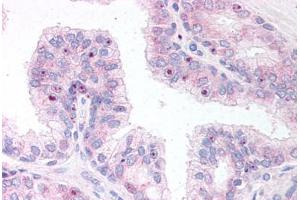 Human Prostate (formalin-fixed, paraffin-embedded) stained with ERG antibody ABIN295774 at 10 ug/ml followed by biotinylated anti-goat IgG secondary antibody ABIN481715, alkaline phosphatase-streptavidin and chromogen. (ERG antibody  (AA 469-481))