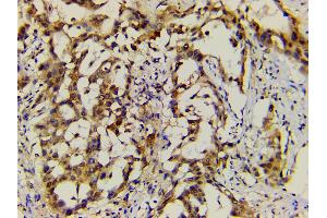 ABIN6277691 at 1/200 staining human lung cancer tissue sections by IHC-P. (Ephrin B2 antibody  (C-Term))