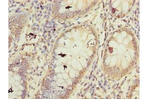 Immunohistochemistry of paraffin-embedded human colon cancer using ABIN7152486 at dilution of 1:100 (BTRC antibody  (AA 701-1000))