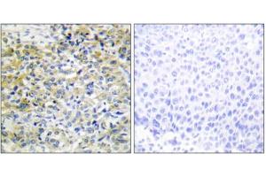 Immunohistochemistry analysis of paraffin-embedded human liver carcinoma tissue using CARKL antibody. (SHPK antibody  (N-Term))