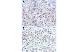 Immunohistochemical analysis of paraffin-embedded human lung cancer (A) and gastric cancer (B) using PAK2 monoclonal antibody, clone 3B5  with DAB staining. (PAK2 antibody)