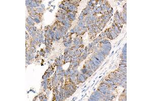 Immunohistochemistry of paraffin-embedded human colon carcinoma using  Rabbit mAb (ABIN7265424) at dilution of 1:1000 (40x lens).