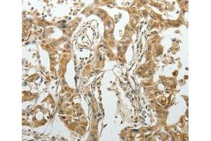Immunohistochemical analysis of paraffin-embedded Human lung cancer tissue using at dilution 1/70. (SUN5 antibody  (Internal Region))