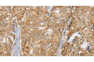 Immunohistochemistry of paraffin-embedded Human breast cancer tissue using SLC9A3R2 Polyclonal Antibody at dilution 1:30 (SLC9A3R2 antibody)