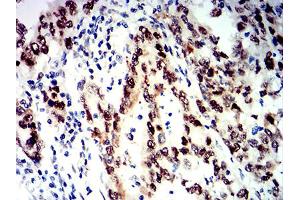 Immunohistochemical analysis of paraffin-embedded stomach cancer tissues using SMARCA1 mouse mAb with DAB staining. (SMARCA1 antibody  (AA 933-1070))