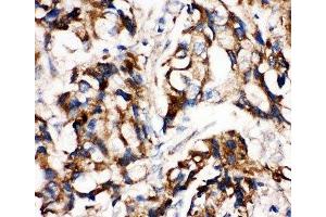 IHC-P: MEK1 antibody testing of human breast cancer tissue (MEK1 antibody  (C-Term))