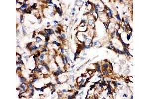 IHC-P: MEK1 antibody testing of human breast cancer tissue (MEK1 antibody  (C-Term))