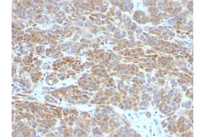 Formalin-fixed, paraffin-embedded human Melanoma stained with Bcl-2 Mouse Monoclonal Antibody (BCL2/782). (Bcl-2 antibody)