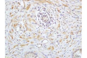 Formalin-fixed and paraffin embedded human prostate labeled with Anti-Phospho-PAK4(Ser99) Polyclonal Antibody, Unconjugated  at 1:200 followed by conjugation to the secondary antibody and DAB staining (PAK4/ 5 (pSer99) antibody)